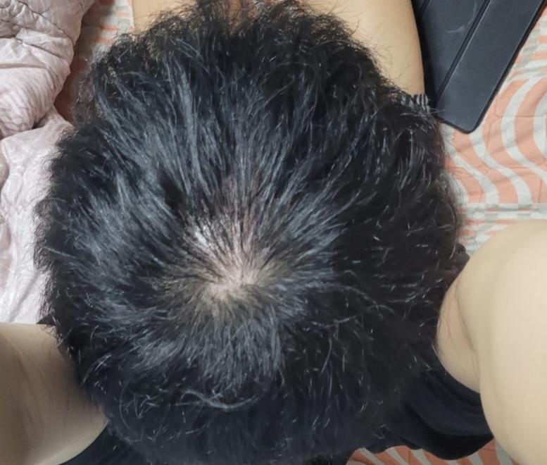 頭皮薄毛症に未緑錠を服用中の方、助けてください 19歳