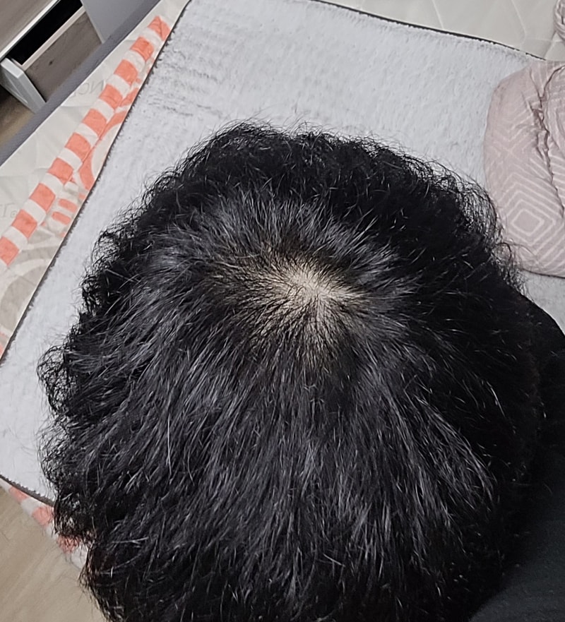 탈모 많이 심각해보이나요? ㅠㅠ