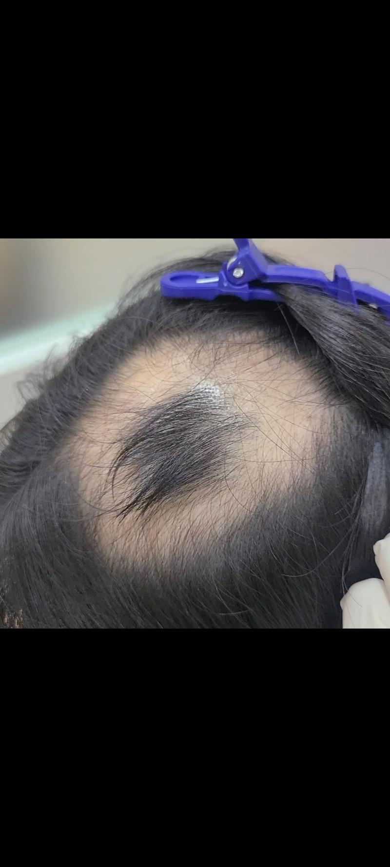 원형탈모로 치료한지 6개월 차입니다.