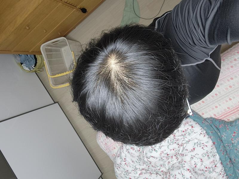 頭頂部の薄毛です