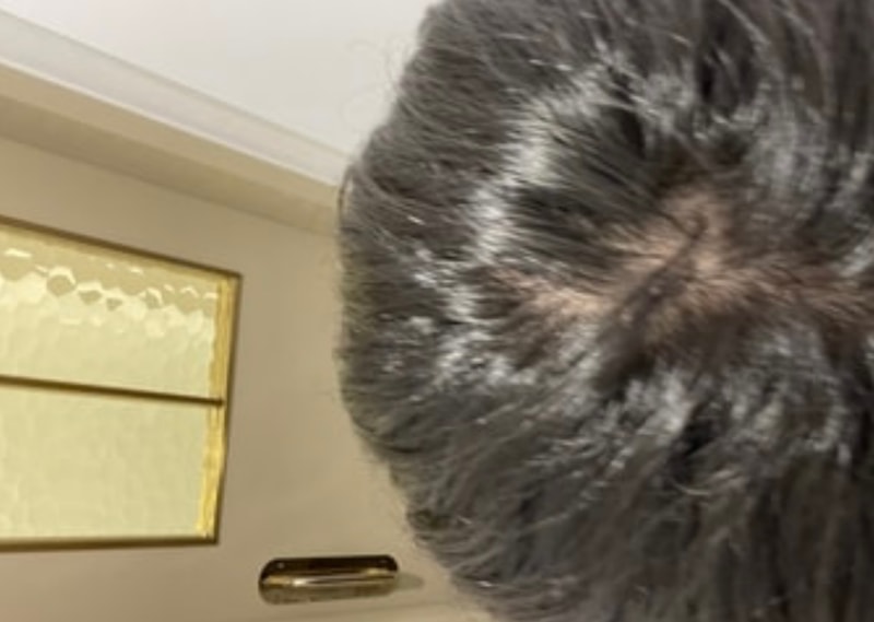 원형탈모 인 것 같아, 너무 죽고 싶고 괴롭습니다.