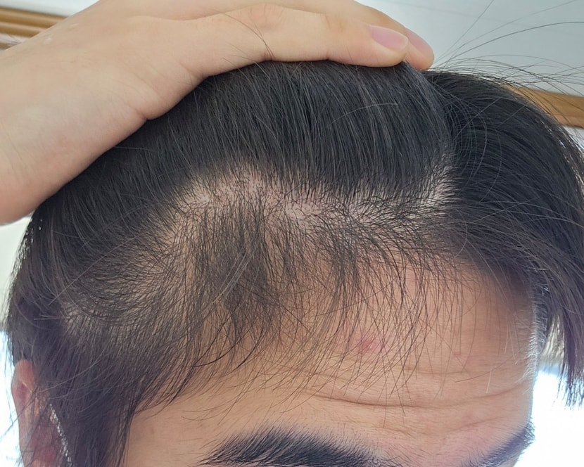 피나1년