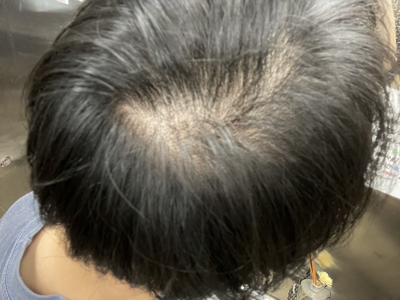 23 years old, I want to die because of serious hair loss on the top of my head