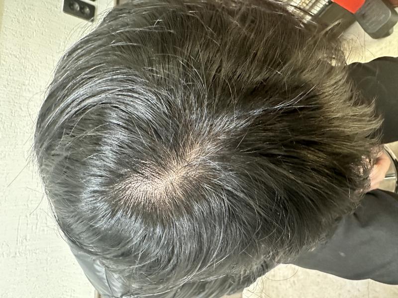 프로페시아 4년 복용후 아보다트로 바꿨습니다