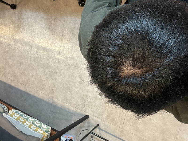 형들 정수리, 가르마에 뭐가 좋나요