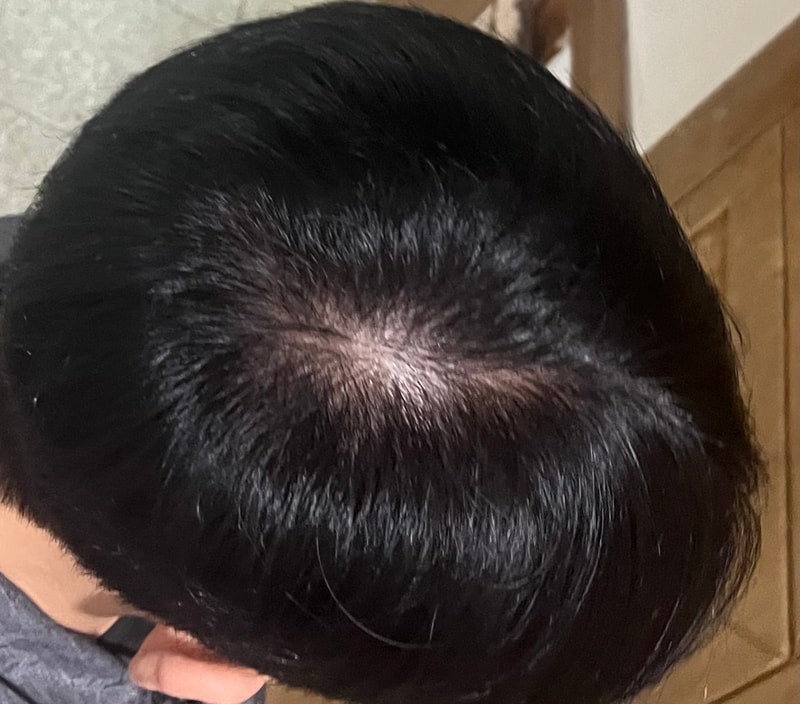 피나+미녹정 1.25mg 시작