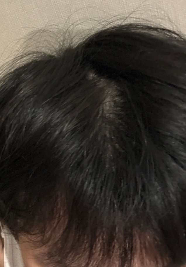 윗머리도혹시이거 탈모 진행되고잇는건가요 ...