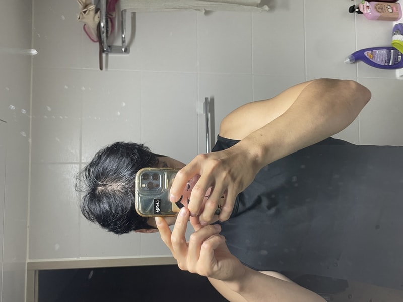 속알머리 탈모ㅠㅠㅠ