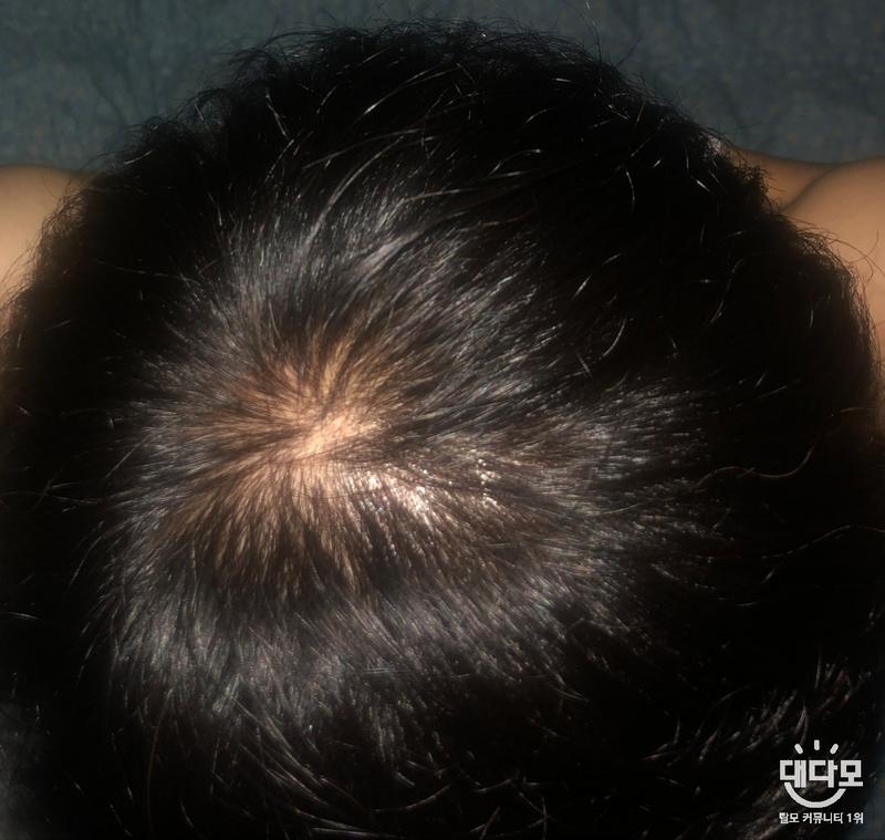 프로페시아 22개월차 기록용