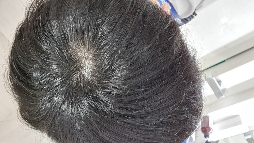 정수리 탈모 일까요?