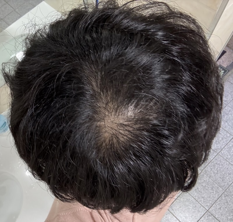 정수리 탈모.. ㅜㅜ 미녹시딜정 먹고있는데 채워질까요?