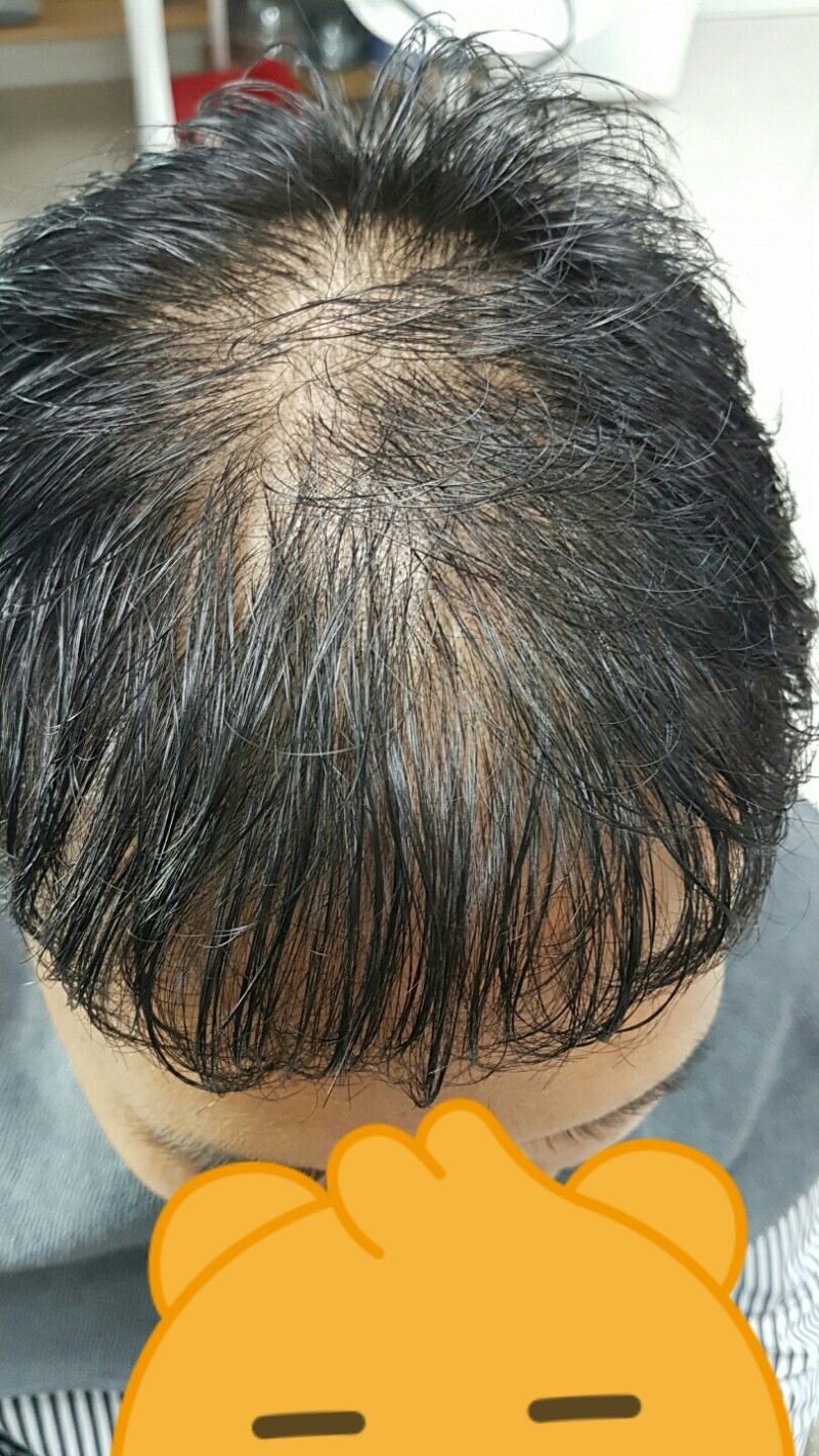 약먹기몇달전쯤 증모하러가서...증모후  견인탈모가 더심해짐...