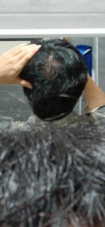 3. 피나 복용 약 1개월차, 오히려 심해짐(8월 29일)