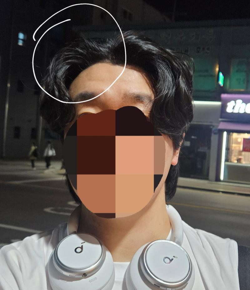 片方のおでこがすごく早く取れますね 涙涙