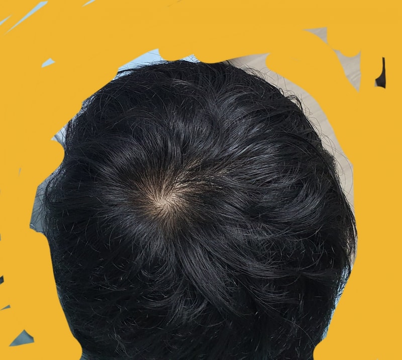 두타스테리드 마지막 보루라던데