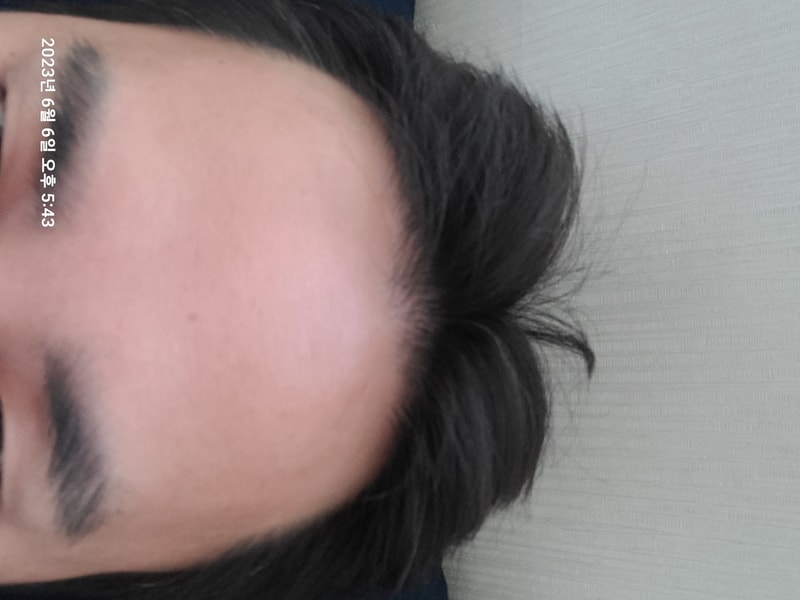 이번에 마지막 3번째 모발이식을 하려고 10년만에 대다모에 다시 왔습니다