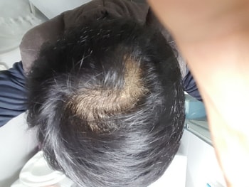 최초탈모 인지당시