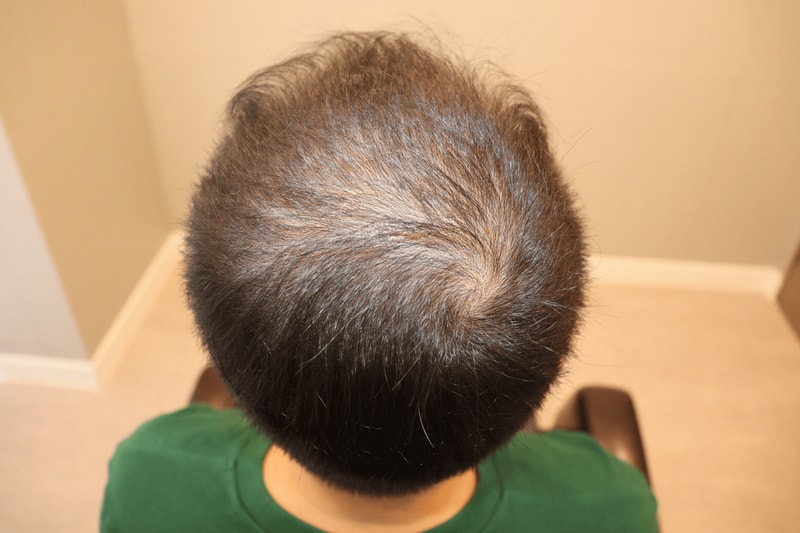 19회만에 정수리 탈모 탈출