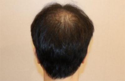 부산 헤어로의원에서 주사치료 5회 받고난 정수리 사진有