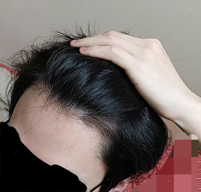 오른쪽 M자라인