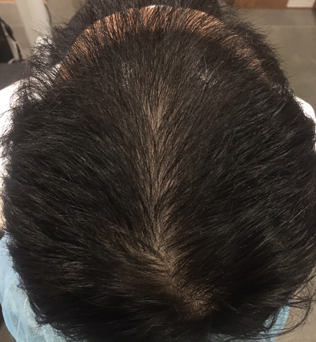 脱发注射治疗 13 次后期