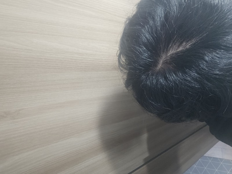탈모약 시작하려합니다!