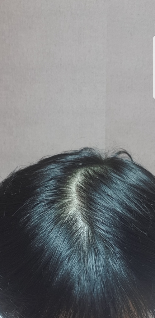 윗머리 탈모
