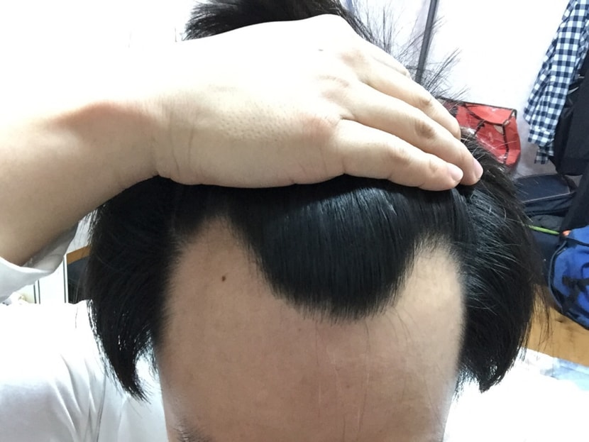 현재 M자 진행 상태입니다.