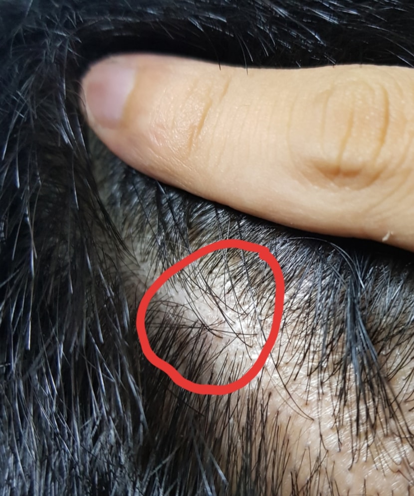 모발이식부분과 기존헤어라인의 경계