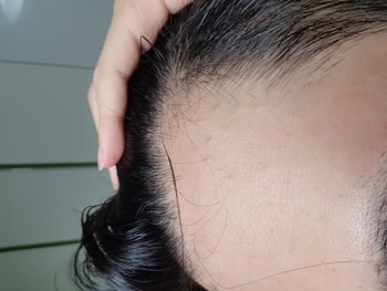 미녹시딜 바르기 전