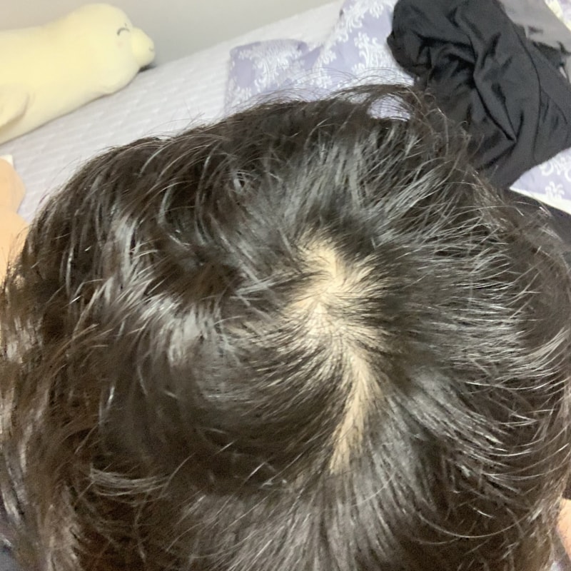 大家一起不要放弃！ Finasterid 9个月后的后记！