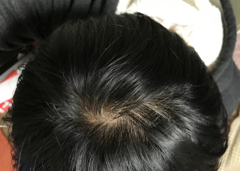 프페카피 먹기 전 정수리