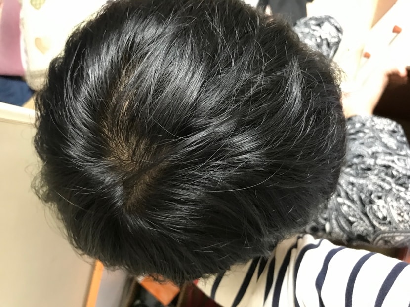 정수리2