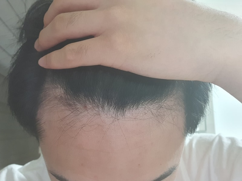 프로페시아에서 아보다트