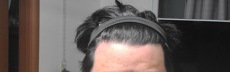 탈모 백프로겟죠?