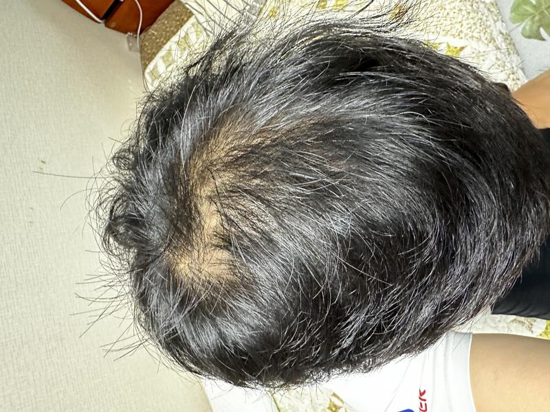 만40세 정수리 탈모입니다. 약 복용하려고하는데 어느정도 회복할까요?
