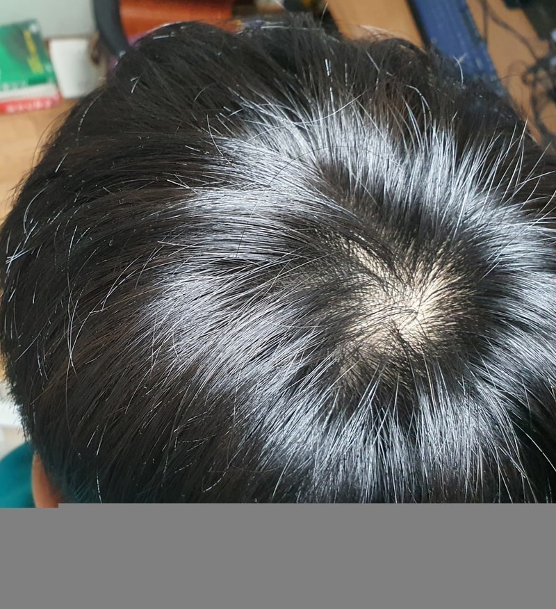 정수리 상태 어떤가요?