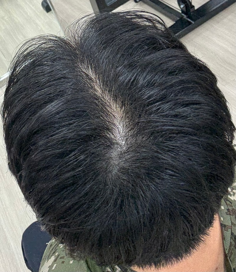 25세 남자 탈모심한가요 ??
