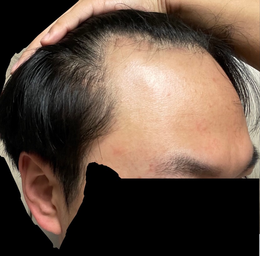 수술전 - 1