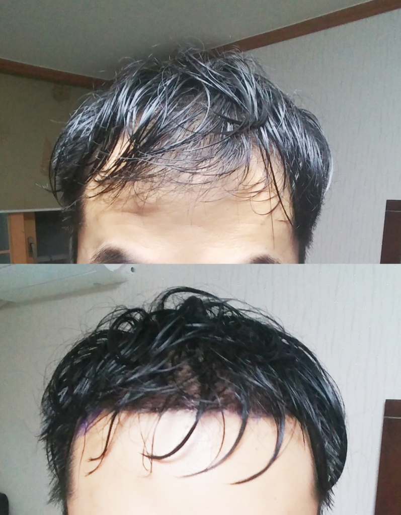 각각 수술 전후 머리감은 직후1