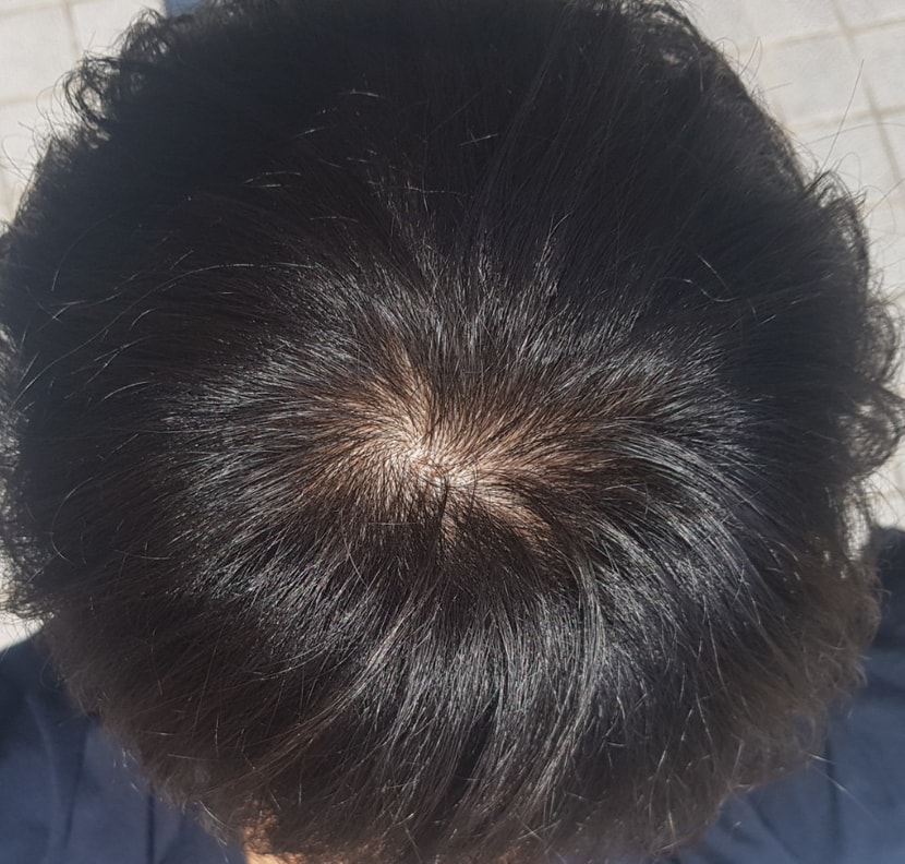 정수리 최근사진