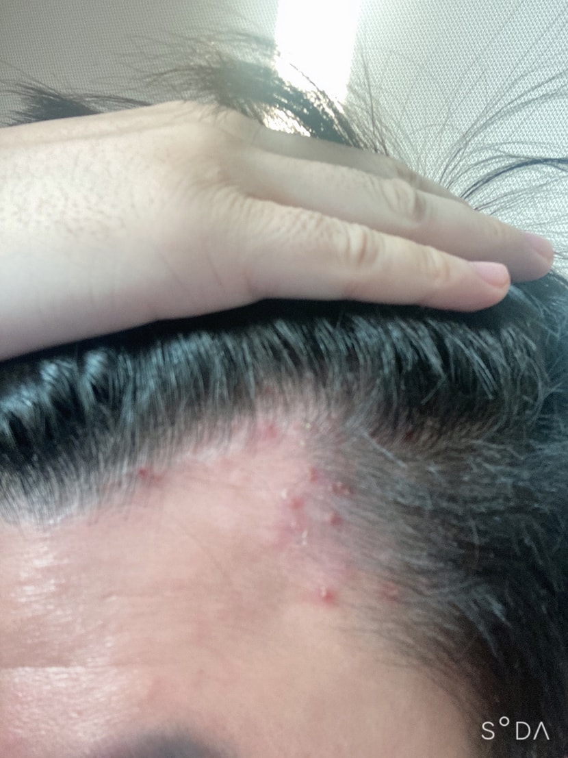 최근 m자부분 반대쪽도 마찬가지