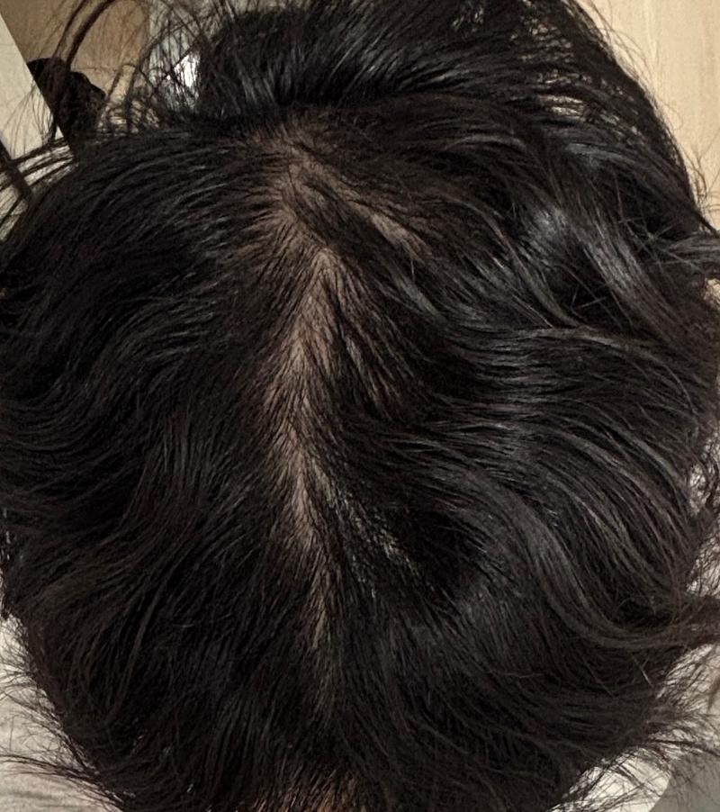 걍 탈모져??