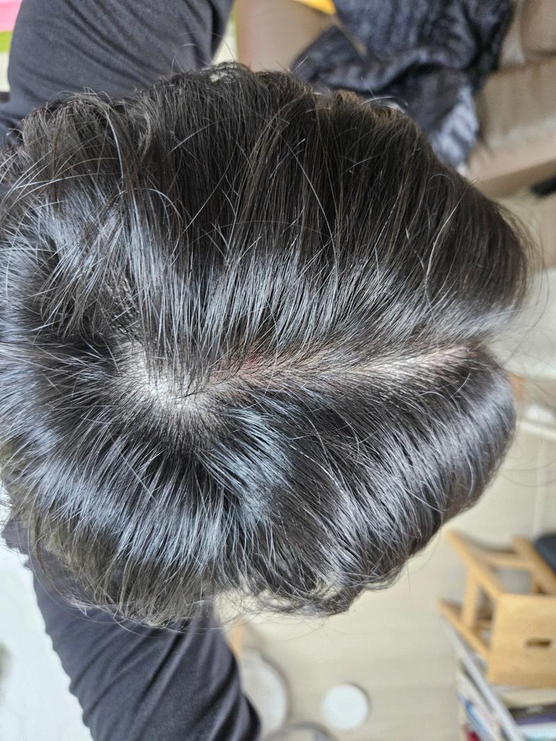 30대 중후반 남자 정수리 탈모인가요?