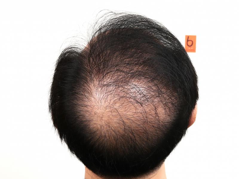 가망이 없어보이던 제 정수리 부산 맘모스에서 줄기세포 치료 받고 희망을 찾았습니다