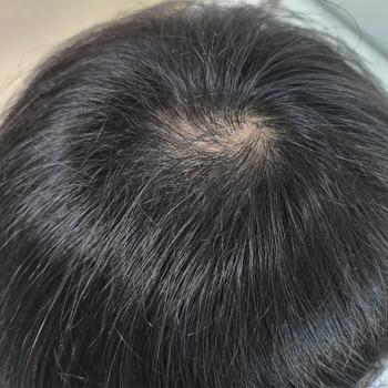 정수리 사진(현재)