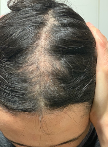 分け目の薄毛でストレスなので、勇気を出して手術を受けようと思います