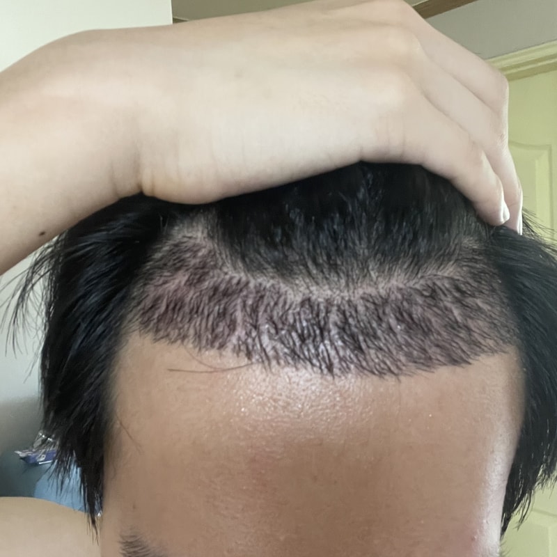 毛髪移植3週目