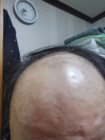 마이녹실과 아보다트 먹기 시작한 날