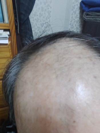 마이녹실 바르고  아보다트 복용 1개월쯤